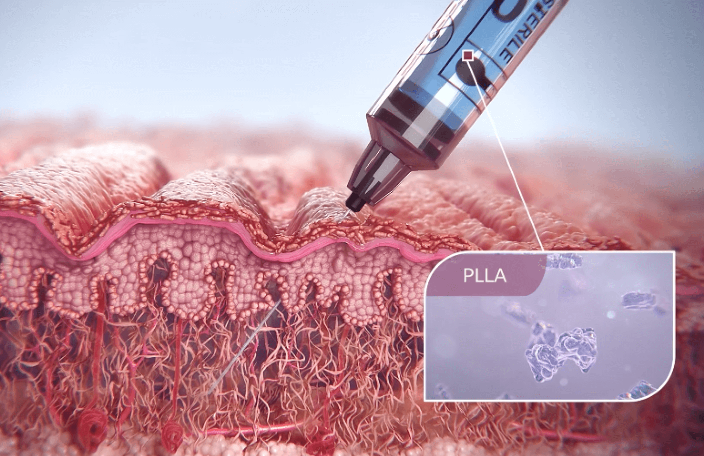 Image of Sculptra injection under the skin