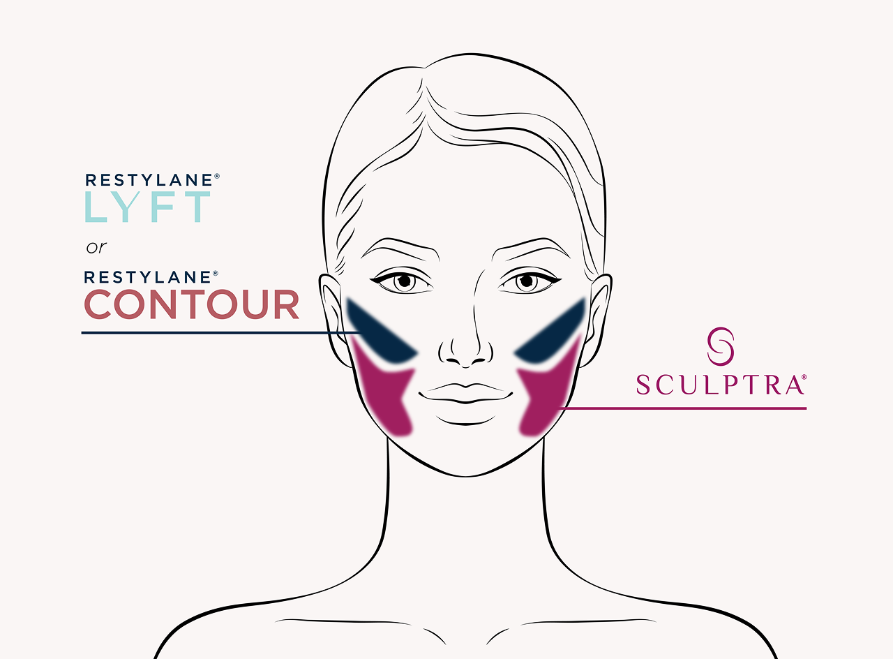 Restylane® Lyft, Restylane® Contour and Sculptura® treatment target areas.